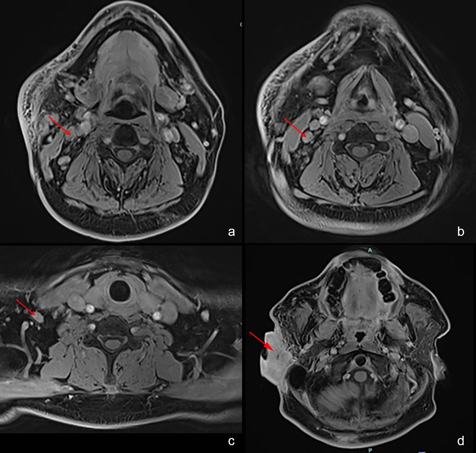FIGURE 2: MRI images showed (a-c) enlarged and enhancing lymph nodes at levels 2, 3, and 4 of the right cervical neck regions; (d) lobulated soft tissue mass measuring 2.6 cm x 4.9 cm x 6.3 cm in the right pre- and postauricular space