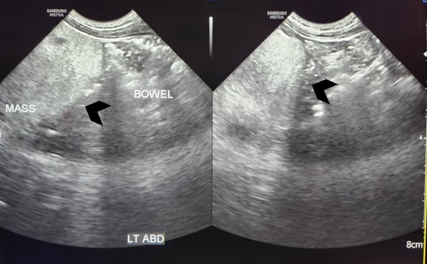 Abdominal ultrasound showed a large lobulated hyperechoic mass occupying abdomen and pelvis (black arrowhead)