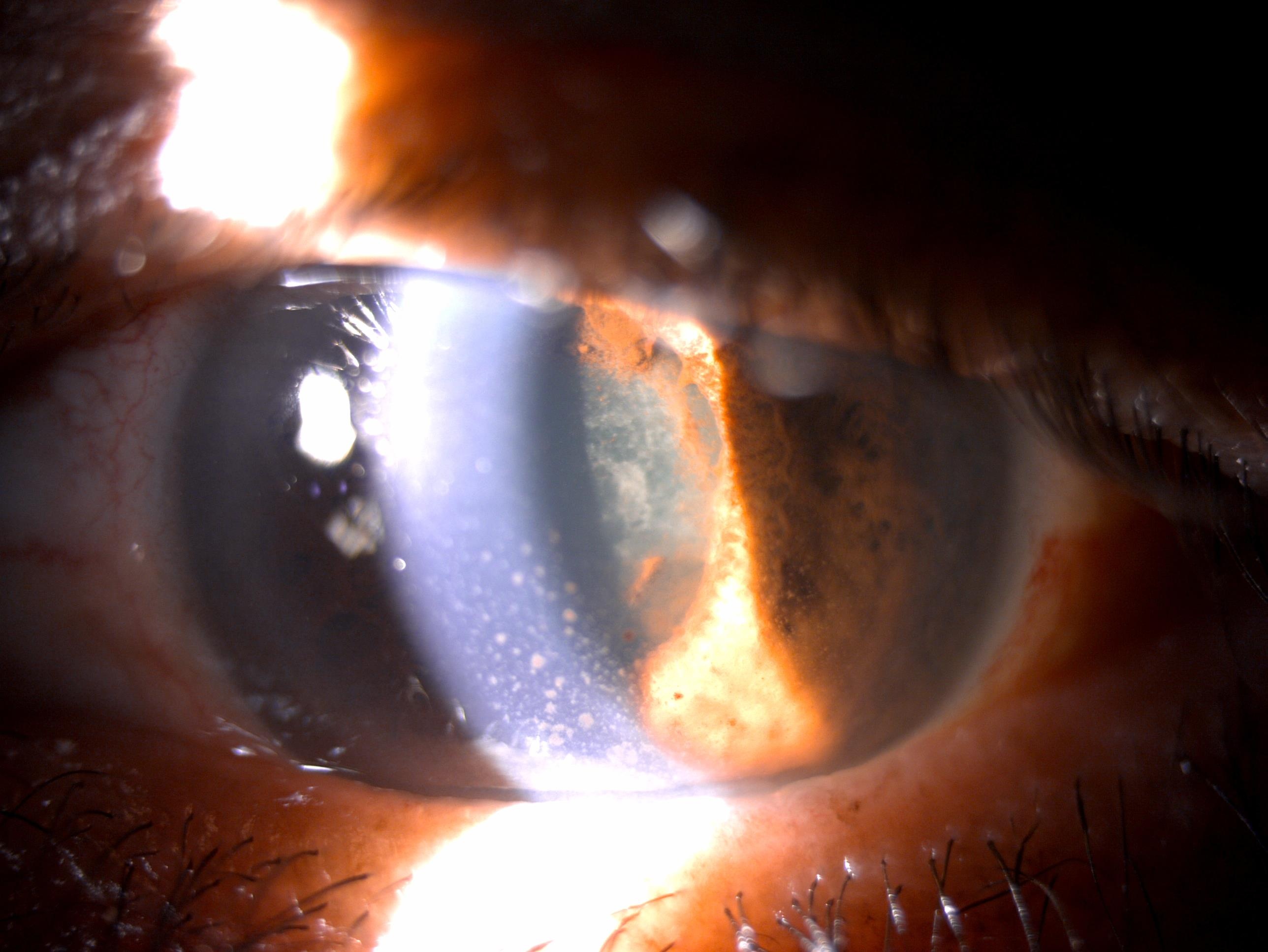 Anterior segment of the left eye with keratic precipitates, seclusio pupillae and dense cataracts