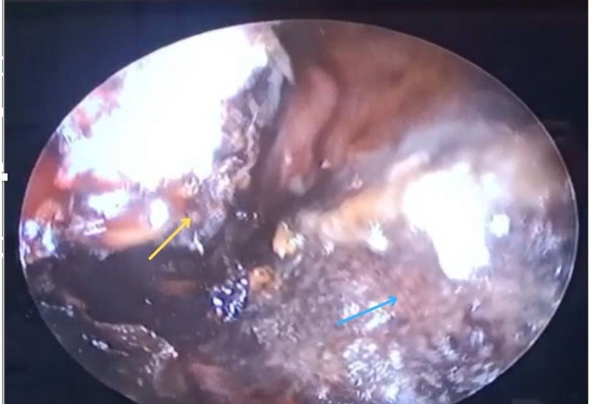 Right nasoendoscopic finding of eschar over the septum (blue arrow) and inferior turbinate (yellow arrow)