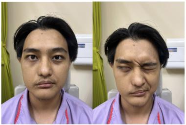 Pre-operative photograph taken 19 days post-trauma of right longitudinal temporal bone fracture, showing right facial nerve palsy House-Brackmann Grade V